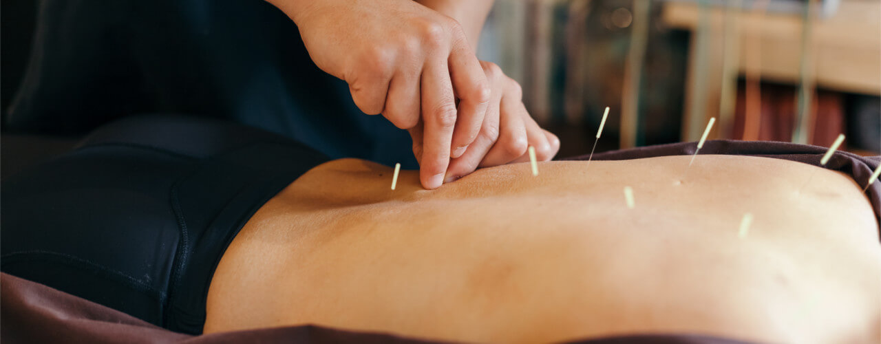Dry Needling Therapy Brisbane