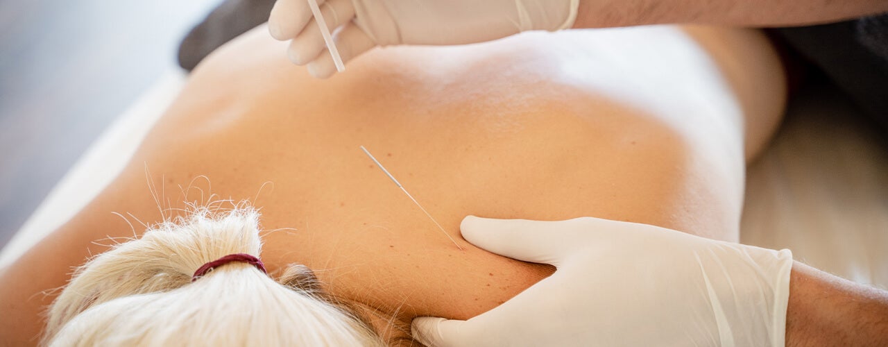 Dry Needling Brisbane